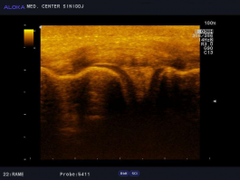 Ultrazvok kolena - počen meniskus